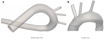 Performance assessment of an electrostatic filter-diverter stent cerebrovascular protection device. Is it possible not to use anticoagulants in atrial fibrilation elderly patients?